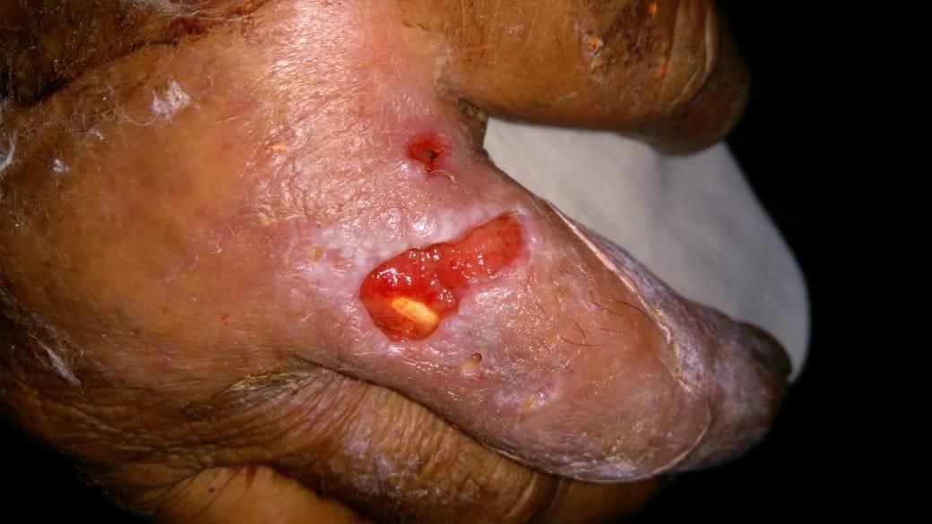 scorpion lesion